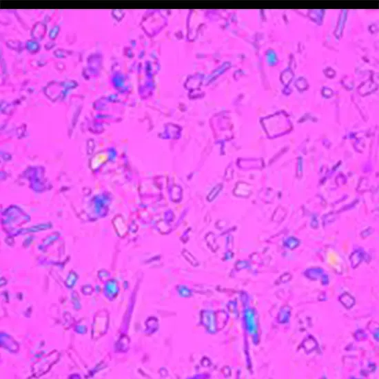 Synovial Fluid For Crystals